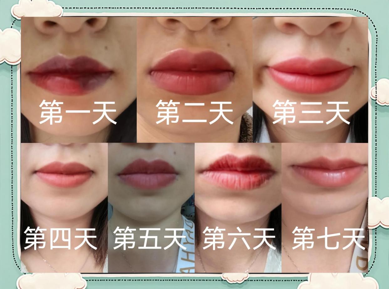 露美纹唇恢复期每天唇色变化对比图